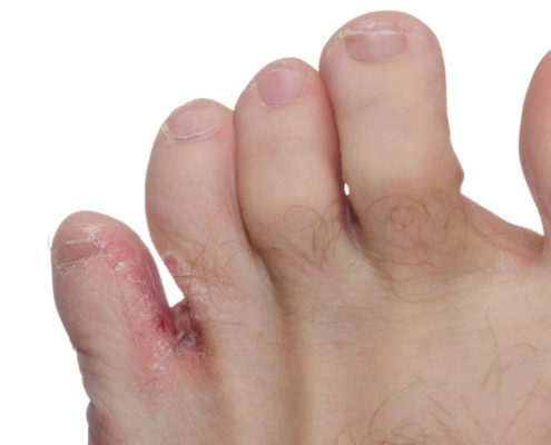 Athlete's Foot (Tinea Pedis) - The Tetra Corporation