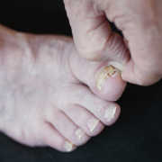Tetra_BG_8.31.26 fungal toenail