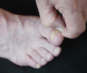 fungal toenail