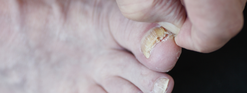 fungal toenail