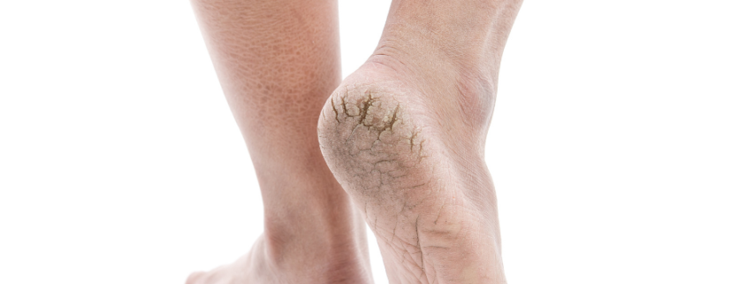 dry cracked heels